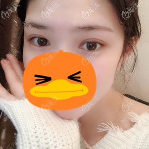 一年前在福州找做的全切雙眼皮，眼睛變大后大家都以為我戴了美瞳