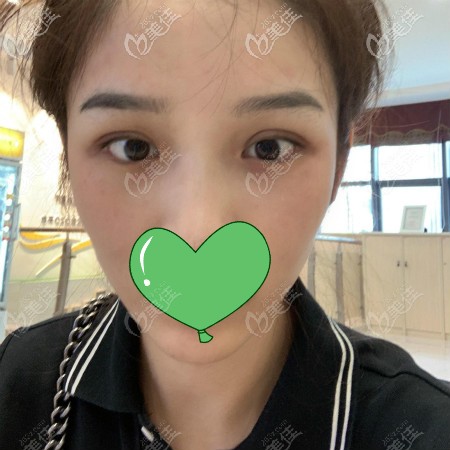 在武漢正璞醫(yī)療美容割雙眼皮2個月效果 在武漢正璞醫(yī)療美容割雙眼皮2個月效果
