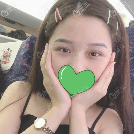 不敢相信！武漢正璞做全切開扇形雙眼皮才6000塊，好看又不貴