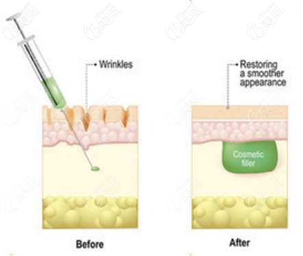 錐形注射手法 錐形注射手法