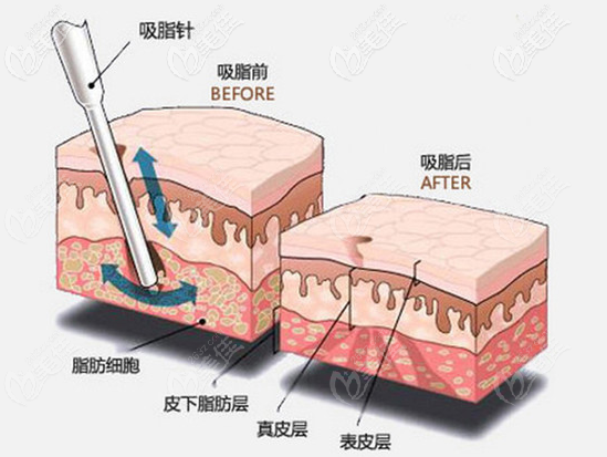 星燦宮張勇醫(yī)生吸脂手術(shù)效果示意圖 星燦宮張勇醫(yī)生吸脂手術(shù)效果示意圖