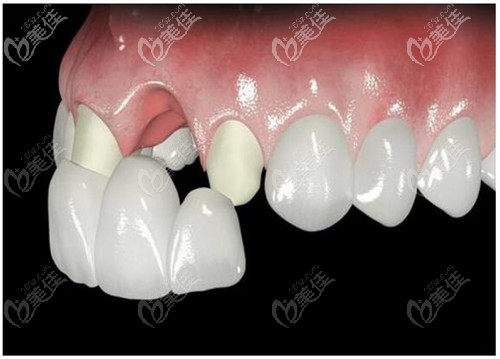 烤瓷牙修復(fù)牙齦萎縮