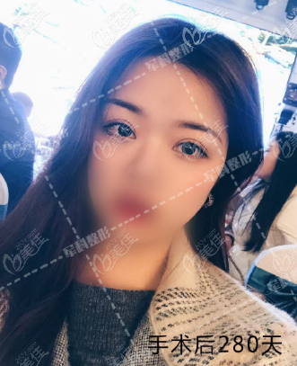 重慶軍科這個醫(yī)生做全切新月形雙眼皮和眼修復(fù)樣子都可以