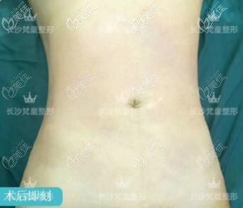 說實話，看到長沙梵童多維水溶腰腹吸脂術后即刻效果讓我蠻吃驚的！