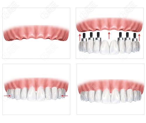 口腔做韓國(guó)進(jìn)口登騰半口種植牙