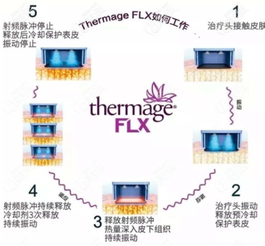 5代熱瑪吉工作原理及功效 5代熱瑪吉工作原理及功效