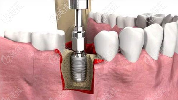 滿口種植牙多少錢