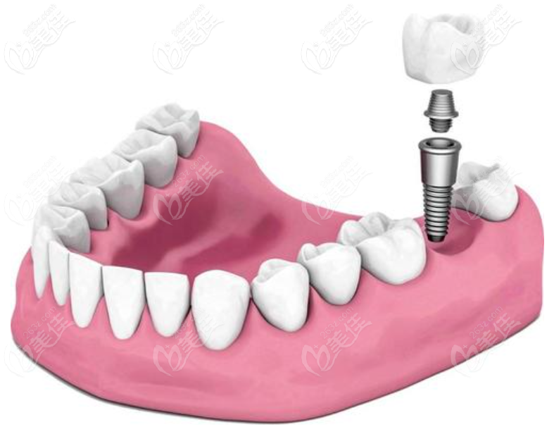意大利BB種植牙優(yōu)勢