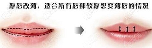 厚唇改薄手術(shù)的效果對(duì)比 厚唇改薄手術(shù)的效果對(duì)比