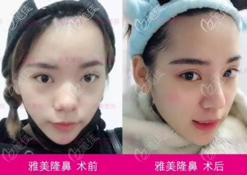 雅美隆鼻真人案例對比展示圖