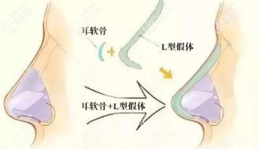 北京星燦宮王佳俊波德黃金三角美鼻術(shù)隆鼻效果示意圖 北京星燦宮王佳俊波德黃金三角美鼻術(shù)隆鼻效果示意圖