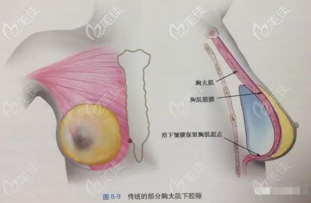 傳統(tǒng)的胸大肌下放置隆胸假體