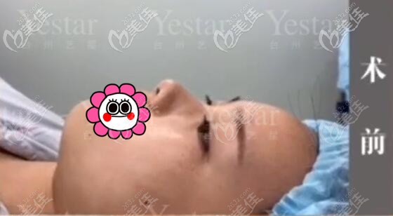 到臺(tái)州藝星做隆鼻前 到臺(tái)州藝星做隆鼻前