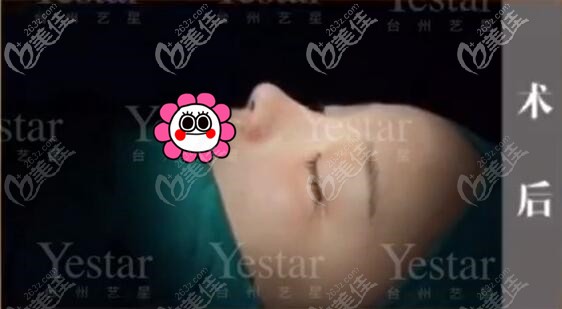 臺(tái)州藝星李星星隆鼻術(shù)后即刻 臺(tái)州藝星李星星隆鼻術(shù)后即刻