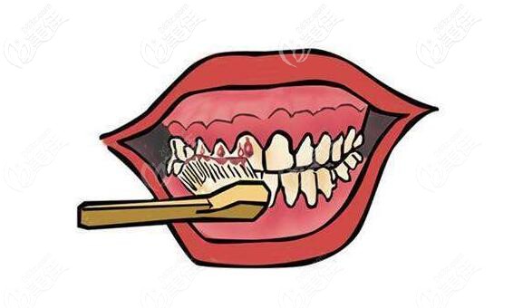 牙周炎的預(yù)防