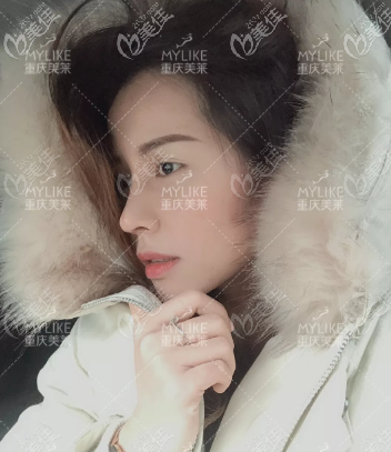 沒(méi)想到我用特價(jià)在重慶美萊做的肋骨鼻綜合效果沒(méi)打折！