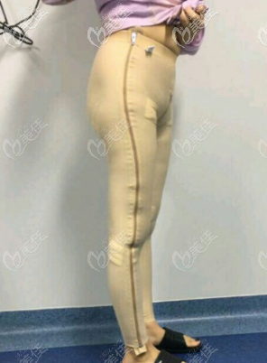 張勇醫(yī)生給我做大腿吸脂術后當天照 張勇醫(yī)生給我做大腿吸脂術后當天照