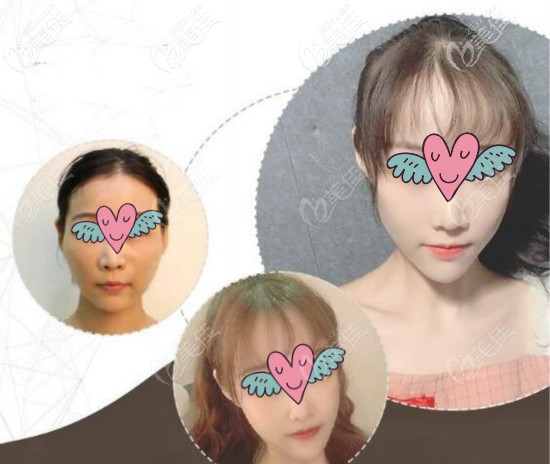 顴骨高做一針降顴骨案例效果圖 顴骨高做一針降顴骨案例效果圖