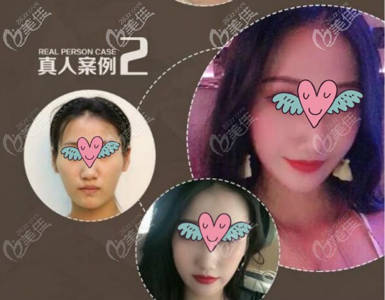 顴骨高做顴骨針降顴骨案例效果對比圖 顴骨高做顴骨針降顴骨案例效果對比圖