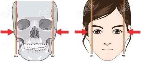 一針降顴骨原理 一針降顴骨原理