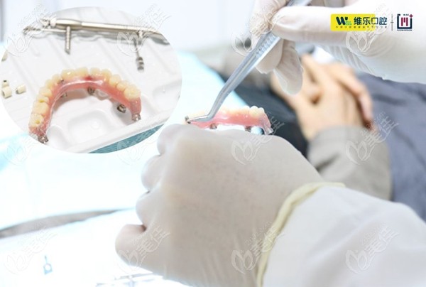 謝大叔臨時牙冠