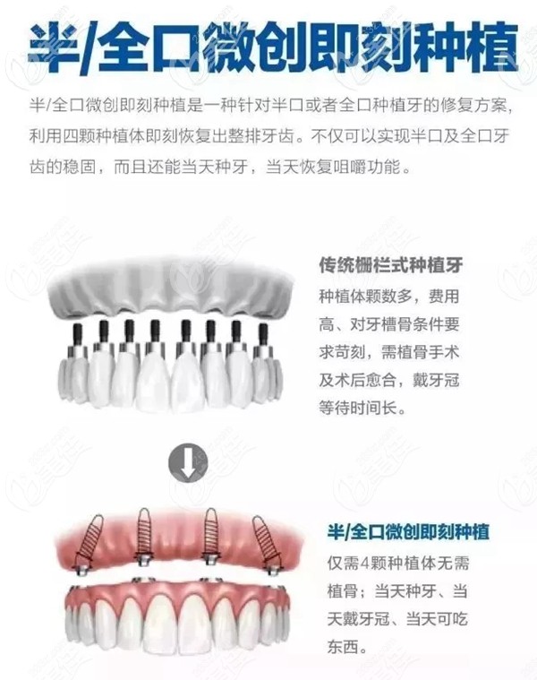 全口即刻種植和普通種植的優(yōu)勢