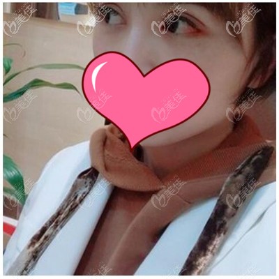 雙眼皮術(shù)后1個(gè)月 雙眼皮術(shù)后1個(gè)月