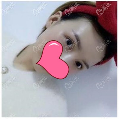 眼皮松弛找楊勝發(fā)做了個全切扇形雙眼皮,恢復(fù)3個月沒留疤還挺自然