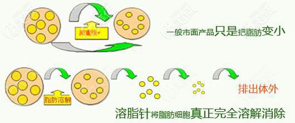 采用溶脂的針劑改善顴骨高的情況