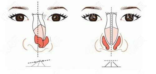 肋軟骨隆鼻歪斜后再次修復(fù)