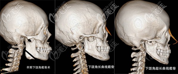 下頜角截骨手術(shù)的演變