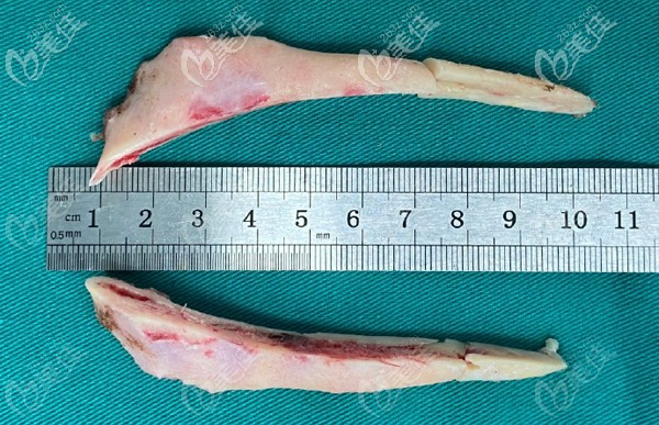 李運峰下頜角超長曲線截骨