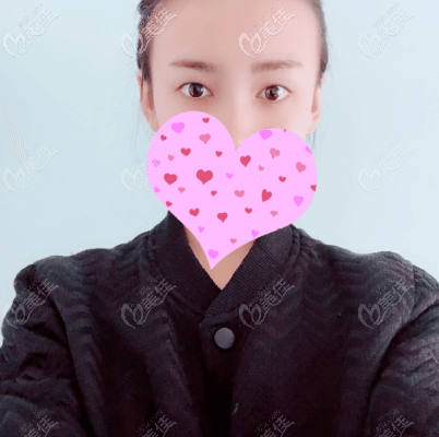 做全切雙眼皮手術(shù)前 做全切雙眼皮手術(shù)前