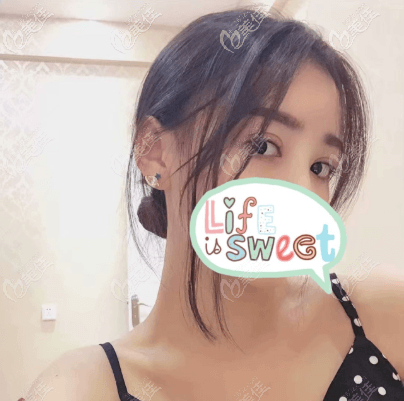 做霍格星眸全切雙眼皮手術(shù)有一個(gè)月了 做霍格星眸全切雙眼皮手術(shù)有一個(gè)月了