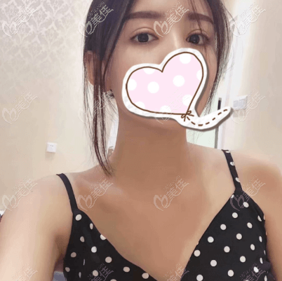 北京星燦宮醫(yī)美機(jī)構(gòu)全切雙眼皮案例 北京星燦宮醫(yī)美機(jī)構(gòu)全切雙眼皮案例