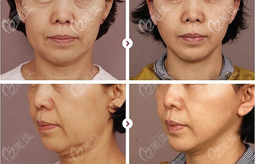 做完四代熱瑪吉后的效果對比 做完四代熱瑪吉后的效果對比