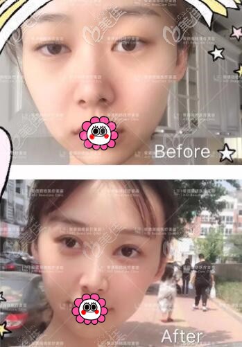 馮守運雙眼皮真人案例前后對比照 馮守運雙眼皮真人案例前后對比照