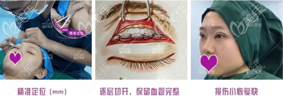 陳宇醫(yī)生給我做的手術(shù)