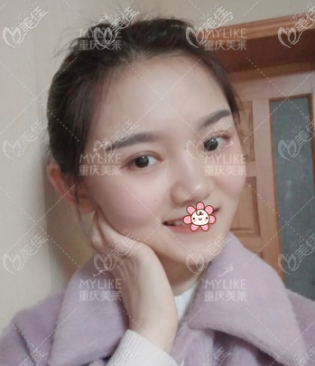 重慶美萊7mm全切平行型雙眼皮3個(gè)月圖片
