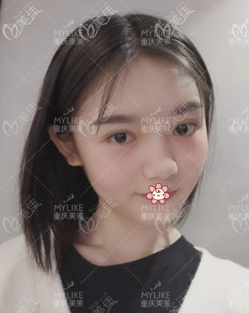 7mm平行形雙眼皮圖片<span style=