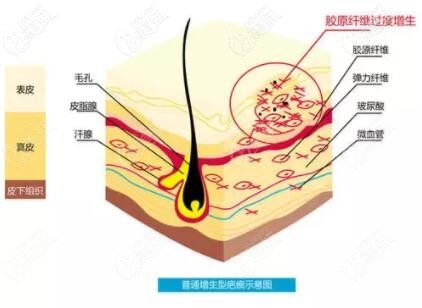普通增生型疤痕示意圖 普通增生型疤痕示意圖