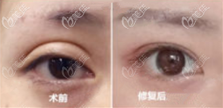雙眼皮外折改內(nèi)折案例圖 雙眼皮外折改內(nèi)折案例圖