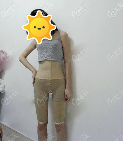 在北京童仁做腰腹吸脂術(shù)后頭一日樣子