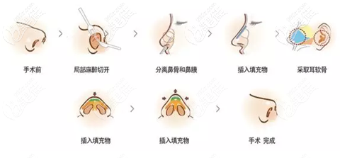 王德寧醫(yī)生耳軟骨隆鼻手術(shù)過(guò)程