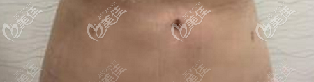 腰腹吸脂后的針眼大小