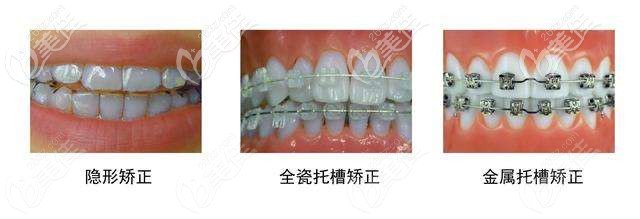 常用的牙齒矯正器 常用的牙齒矯正器