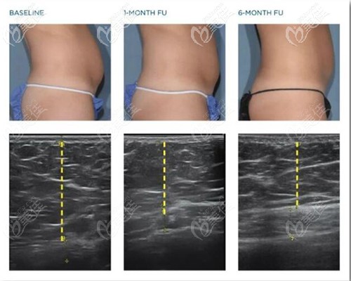 使用美修斯后的變化過程 使用美修斯后的變化過程