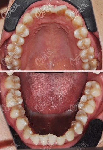 做牙齒矯正前牙齒不齊還前凸 做牙齒矯正前牙齒不齊還前凸