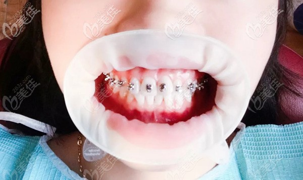 剛戴上牙套酸疼不適應(yīng) 剛戴上牙套酸疼不適應(yīng)