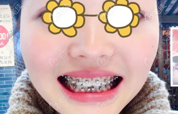 戴牙套間隙拍照留念 戴牙套間隙拍照留念